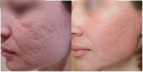 Chemical peeling for the face in the salon and at home. Reviews, before and after photos, pros and cons