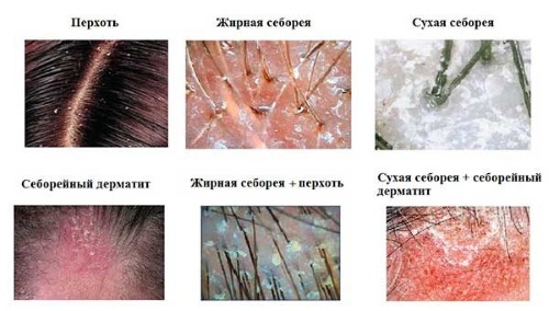 How to cure scabby dandruff, dry skin, seborrhea with baking soda, paint, onions, tea tree oil