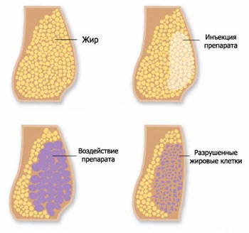 Slimming lipolytics: injections, cocktails, tablets. Cost, before and after photos, doctors' reviews