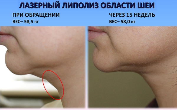 Chin liposuction with laser. Photos, how the procedure is carried out, the period of rehabilitation, the consequences, reviews