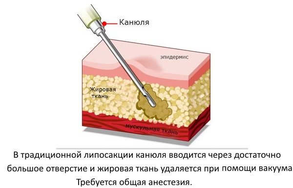 Chin liposuction with laser. Photos, how the procedure is carried out, the period of rehabilitation, the consequences, reviews