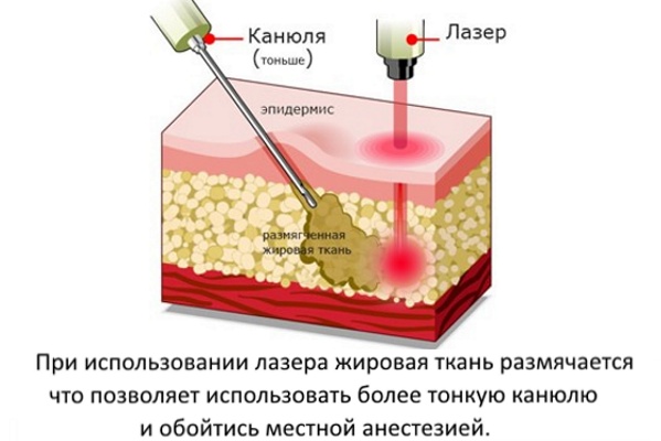 Liposuzione del mento con laser. Foto, come viene eseguita la procedura, il periodo di riabilitazione, conseguenze, recensioni