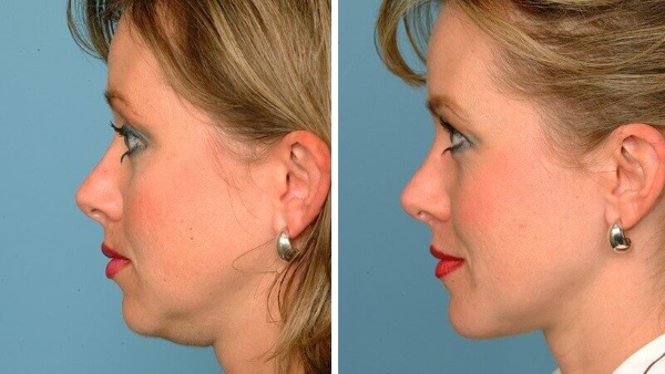 Chin liposuction with laser. Photos, how the procedure is carried out, the period of rehabilitation, the consequences, reviews