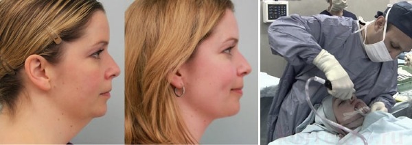 Chin liposuction with laser. Photos, how the procedure is carried out, the period of rehabilitation, the consequences, reviews