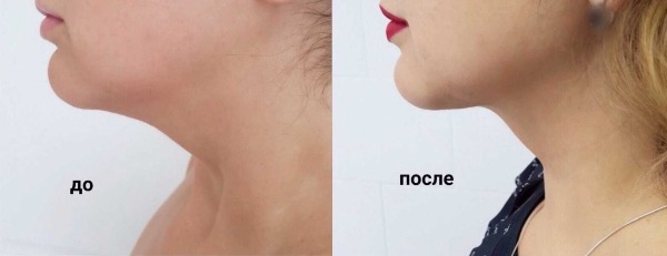 Chin liposuction with laser. Photos, how the procedure is carried out, the period of rehabilitation, the consequences, reviews