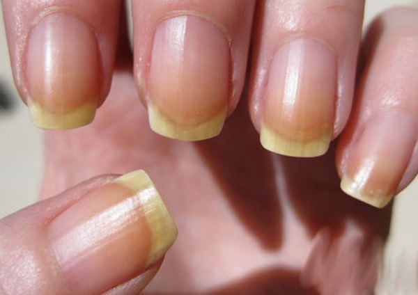 How to strengthen nails so that they do not exfoliate and do not break at home The reason for fragility, how to treat