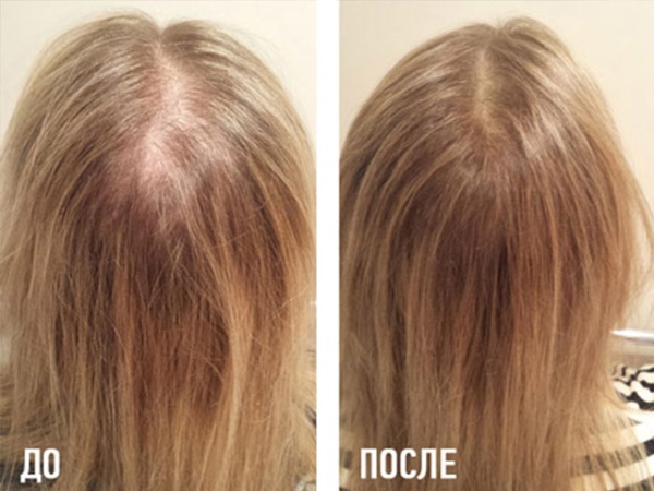 Acido nicotinico in compresse per capelli, maschere per la crescita. Istruzioni per l'uso, recensioni dei medici