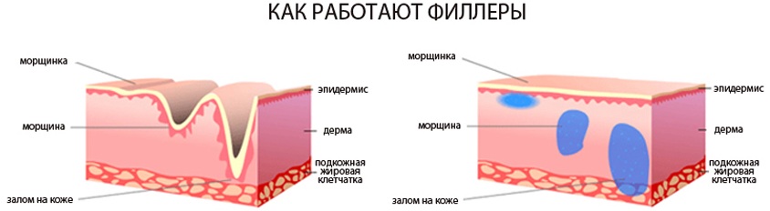 Fillers in nasolabials. Reviews, photos before and after correction. The effectiveness of the procedure, consequences and possible complications