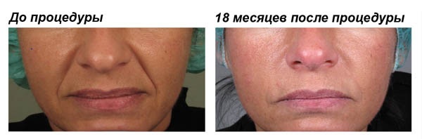 Fillers in nasolabials. Reviews, photos before and after correction. The effectiveness of the procedure, consequences and possible complications