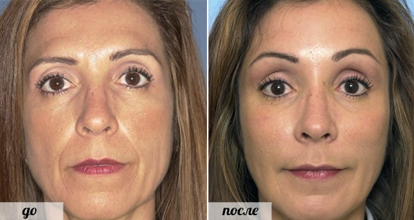 Fillers in nasolabials. Reviews, photos before and after correction. The effectiveness of the procedure, consequences and possible complications