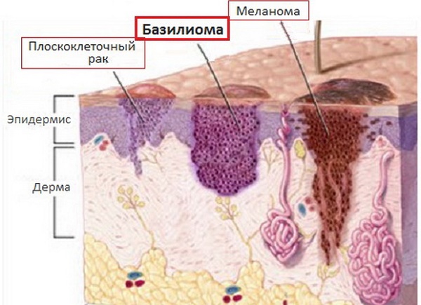 Hautneoplasmen: Fotos und Beschreibungen von Kopf, Armen, Gesicht und Körper. Wie man gutartige und bösartige Neubildungen behandelt