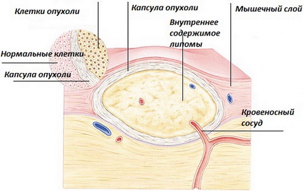 Hautneoplasmen: Fotos und Beschreibungen von Kopf, Armen, Gesicht und Körper. Wie man gutartige und bösartige Neubildungen behandelt