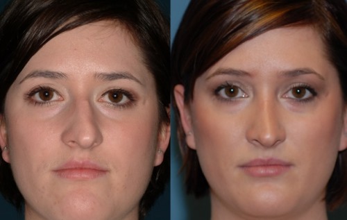 Nasal septum surgery: postoperative period, nose care after correction, rehabilitation. A photo