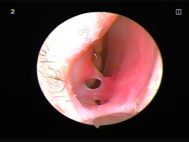 Nasal septum surgery: postoperative period, nose care after correction, rehabilitation. A photo