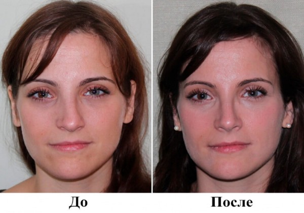 Nasal septum surgery: postoperative period, nose care after correction, rehabilitation. A photo