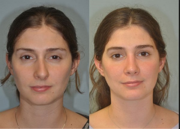 Nasal septum surgery: postoperative period, nose care after correction, rehabilitation. A photo