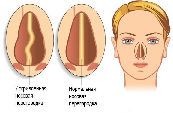 Nasal septum surgery: postoperative period, nose care after correction, rehabilitation. A photo