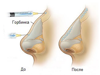 Operation to reduce the nose: wings, tip, how to do, before and after photos