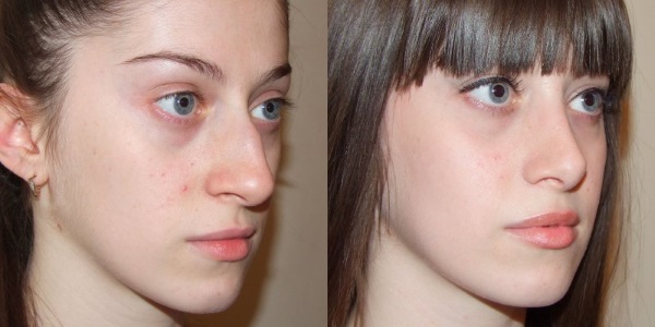 Operation to reduce the nose: wings, tip, how to do, before and after photos