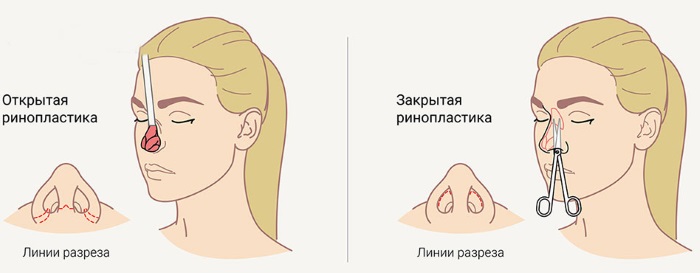 Operation to reduce the nose: wings, tip, how to do, before and after photos