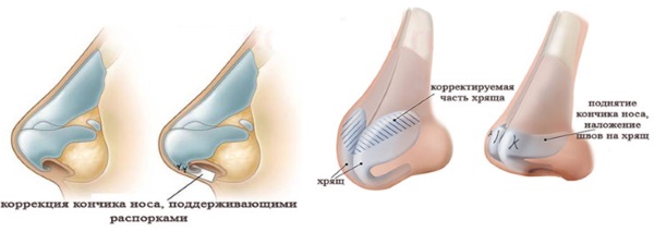 Operation to reduce the nose: wings, tip, how to do, before and after photos