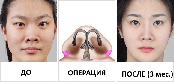 Operation to reduce the nose: wings, tip, how to do, before and after photos