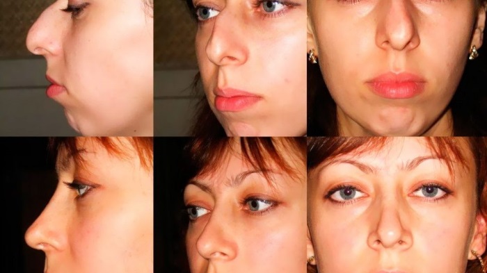 Operation to reduce the nose: wings, tip, how to do, before and after photos