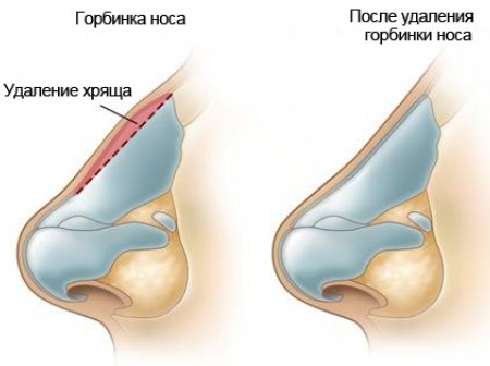 Operation to reduce the nose: wings, tip, how to do, before and after photos