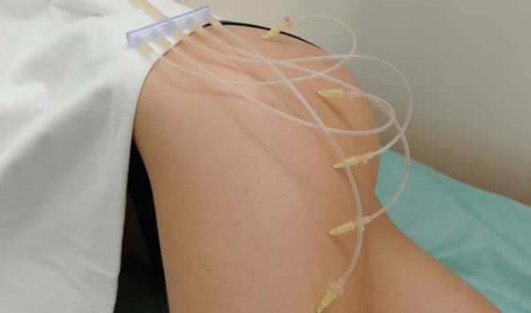 Intravenöse Ozontherapie. Bewertungen von Ärzten, Indikationen und Kontraindikationen, Nutzen und Schaden, Behandlungsverlauf, ist während der Schwangerschaft möglich