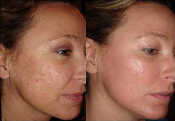 Acid face peels: professional formulations for home use. Efficiency and how to use