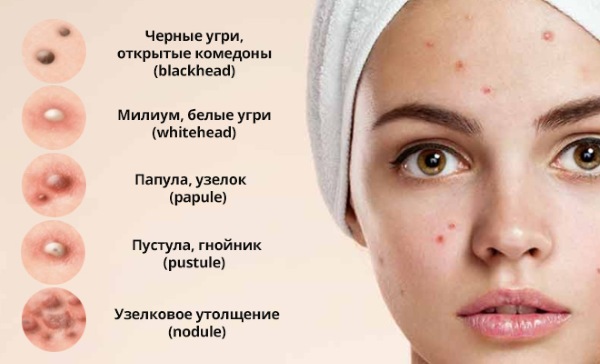 Causes of acne on the forehead in women, which organ is not in order? How to get rid of at home, treatment