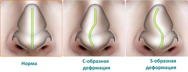 Rhinoplasty of the nose, non-surgical, closed, open, reconstructive, injection, rehabilitation