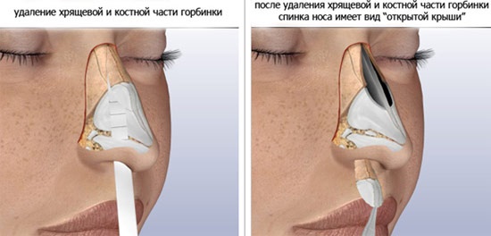 Rhinoplasty of the nose, non-surgical, closed, open, reconstructive, injection, rehabilitation