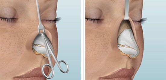 Rhinoplasty of the nose, non-surgical, closed, open, reconstructive, injection, rehabilitation