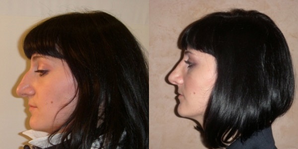 Rhinoplasty of the nose, non-surgical, closed, open, reconstructive, injection, rehabilitation