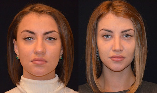 Rhinoplasty of the nose, non-surgical, closed, open, reconstructive, injection, rehabilitation