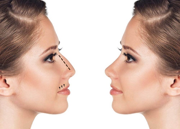 Rhinoplasty of the nose, non-surgical, closed, open, reconstructive, injection, rehabilitation