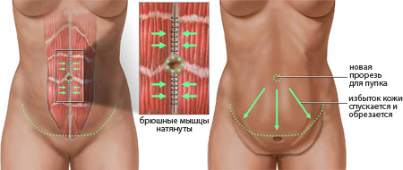 How to make the waist thinner, remove the belly and sides in a week. A set of exercises at home