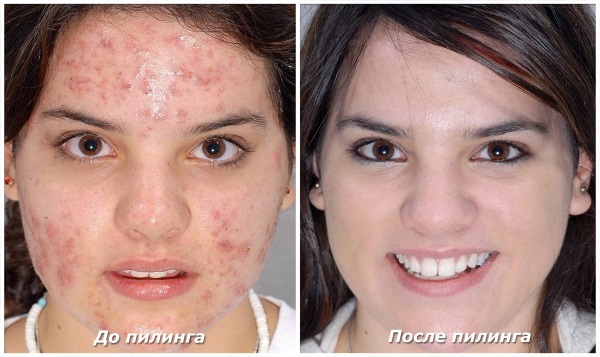 Remedies for acne on the face for adolescents in the pharmacy, folk. Rating. How to get rid of acne at home