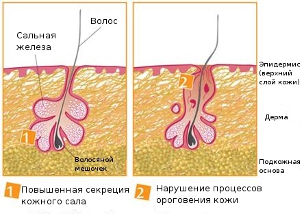 Remedies for acne on the face for adolescents in the pharmacy, folk. Rating. How to get rid of acne at home