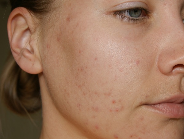 Remedies for acne spots on the face. The best in the pharmacy and effective folk. How to quickly remove pigmentation at home