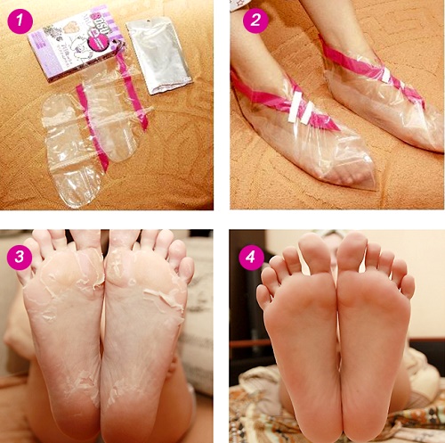 Remedies for cracked heels: folk with glycerin, ammonia, vinegar, egg, peroxide, aloe, vitamin E, calendula