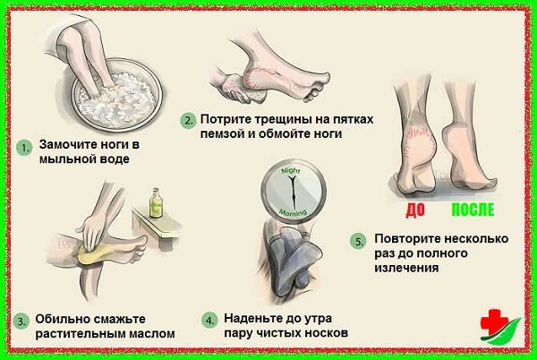 Rimedi per i talloni screpolati: gente con glicerina, ammoniaca, aceto, uova, perossido, aloe, vitamina E, calendula