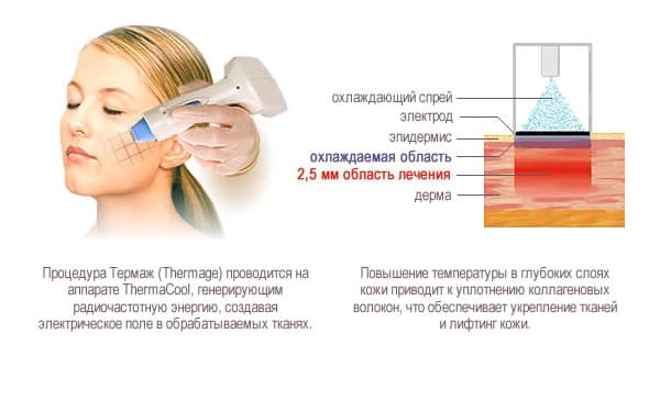 Facial thermage - what is this procedure, how is it done, what is the difference with RF-lifting. Photos, results, price, reviews