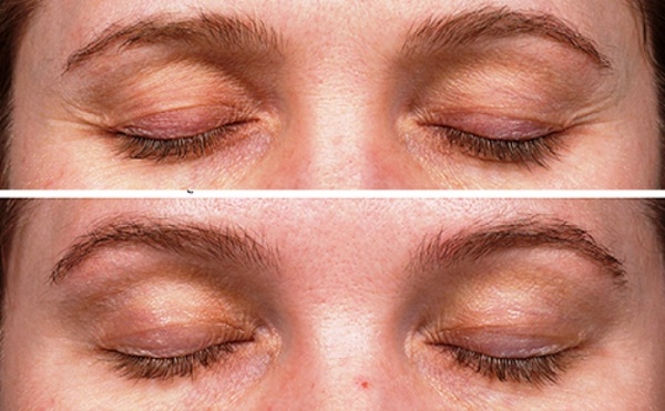 Facial thermage - what is this procedure, how is it done, what is the difference with RF-lifting. Photos, results, price, reviews