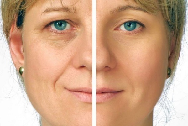 Facial thermage - what is this procedure, how is it done, what is the difference with RF-lifting. Photos, results, price, reviews