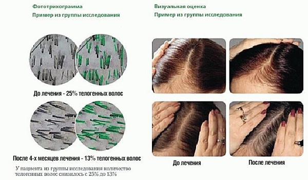 Vitamins for hair loss and growth. Rating of the best from the pharmacy: effective and inexpensive drugs