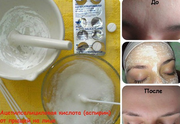 Acetylsalicylic acid for facial skin. Recipes for masks, peeling for acne, wrinkles. Results and photos