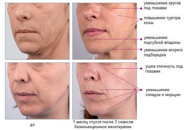 Non-injection hardware facial mesotherapy. What is this procedure, benefits, effectiveness, price