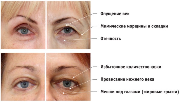 Blepharoplastik. Fotos nach der Operation bei Tag. Komplikationen, Erholung nach kreisförmigen, unteren, oberen. Rehabilitation, Folgen